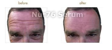 bought Nur76 Serum for my husband, since his lines were getting 